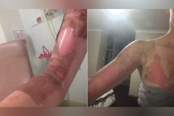 Article image for Thermomix fined $4.6 million after reports of severe burns
