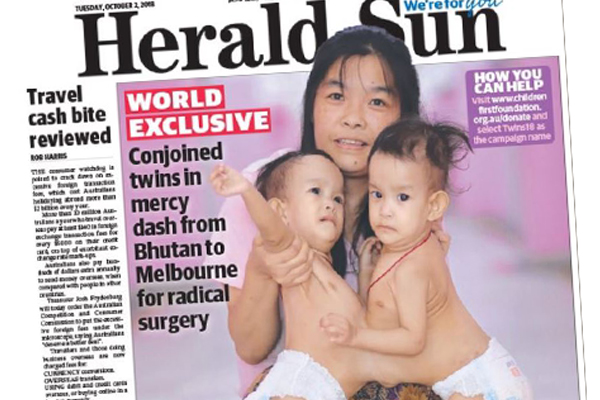 Article image for Surgeons prepare to separate 14-month-old conjoined twins from Bhutan