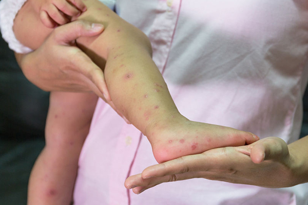 Article image for Health warning issued after third person diagnosed with measles in NSW