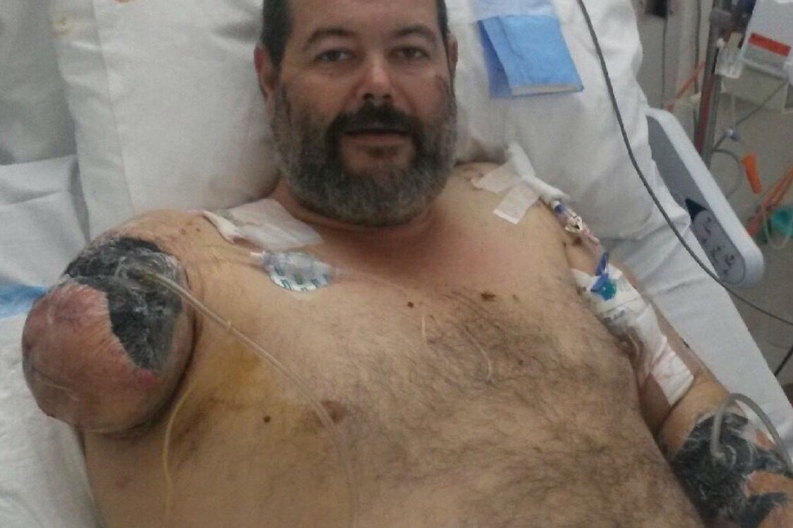 UPDATE | Man out of hospital after having arm amputated in horrific dog attack