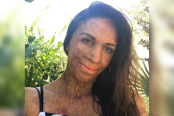 No bitter pills: Turia Pitt’s dose of Kyndness for those in need