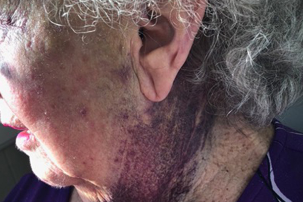 Article image for GRAPHIC IMAGES | Grandma sustains horror injuries during hospital visit