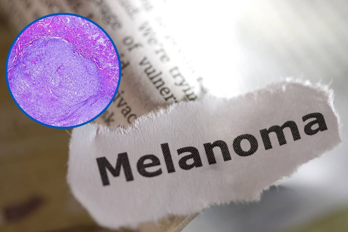 Article image for ‘We cannot tolerate this’: Rising costs stopping Aussies from crucial melanoma checks