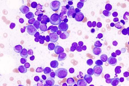 ‘$150,000 lifeline’ – Government subsidy to make multiple myeloma drug accessible