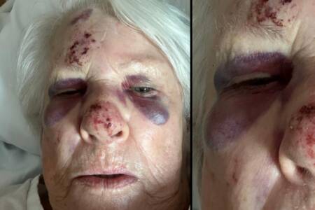 EXCLUSIVE – Elderly woman suffers brain bleed after being hit by E-bike